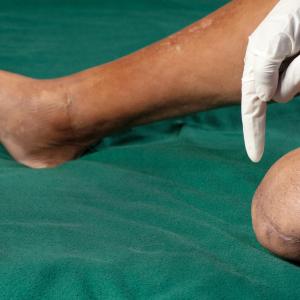 Liver fibrosis, steatosis heighten risk of diabetic peripheral neuropathy