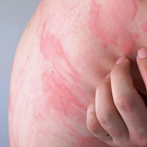 Ligelizumab safe, effective in patients with chronic spontaneous urticaria