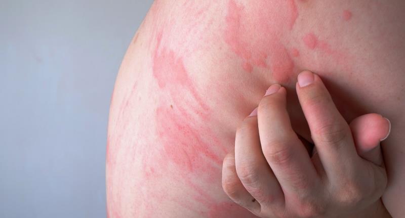 Ligelizumab safe, effective in patients with chronic spontaneous urticaria