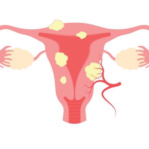 High-intensity focused ultrasound a promising treatment modality for uterine fibroids: SG data