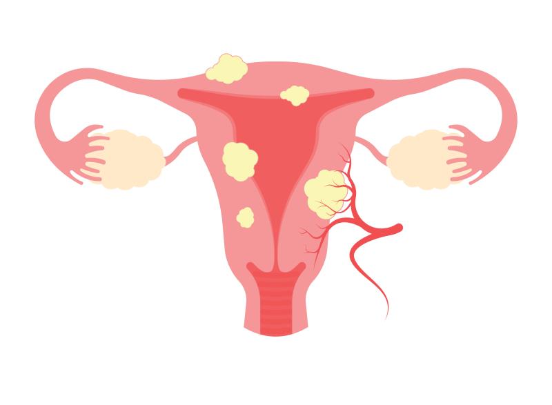 High-intensity focused ultrasound a promising treatment modality for uterine fibroids: SG data