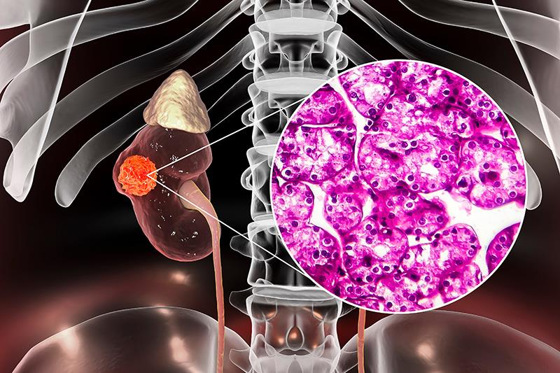 LITESPARK-005: Belzutifan sustains PFS, ORR benefits in advanced renal cell carcinoma