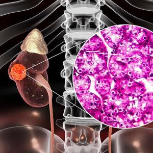 Lenvatinib outdoes other TKIs in improving survival in metastatic RCC