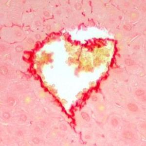 Fibrosis tool also warns of CVD risk