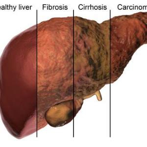 Liver fibrosis may occur in teens with chronic HCV infection