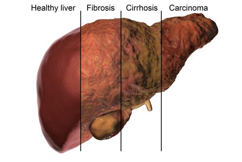 Liver fibrosis may occur in teens with chronic HCV infection