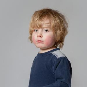 Long-term secukinumab safe, effective in kids with plaque psoriasis