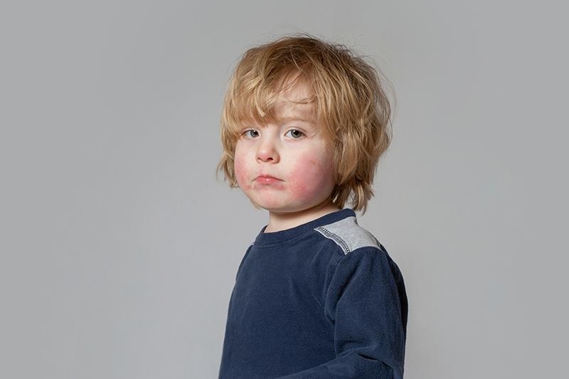 Long-term secukinumab proven safe, effective in kids with chronic plaque psoriasis