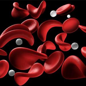 Long-term voxelotor use increases Hb, reduces haemolysis markers in patients with SCD