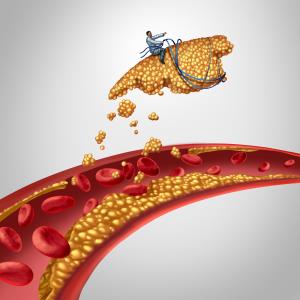 Add-on evolocumab improves plaque characteristics in statin-treated CAD patients