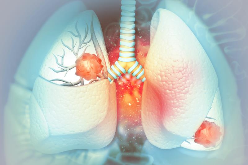 First-line lorlatinib trumps crizotinib for advanced ALK+ lung cancer