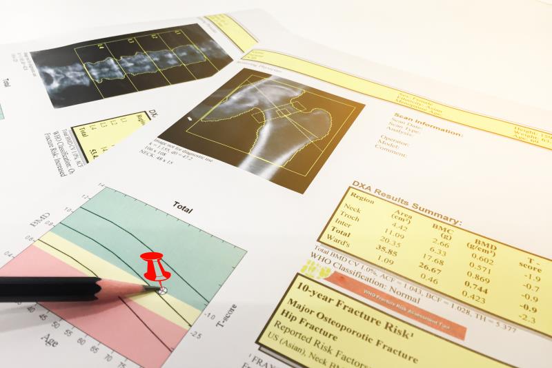 Low BMD, fracture risk upped in childhood cancer survivors