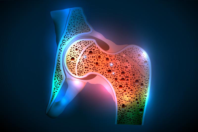 Parkinson’s disease carries heightened risk of hip, nonvertebral fractures