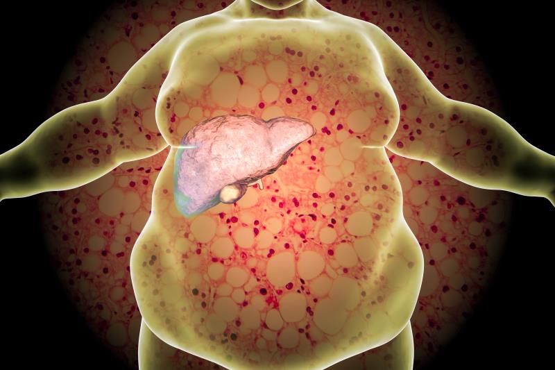 Intrahepatic lipid content tied to soluble E-selectin levels