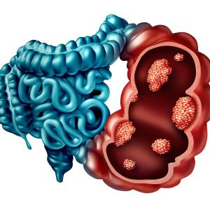 Lower CRC risk with ACEis, ARBs?