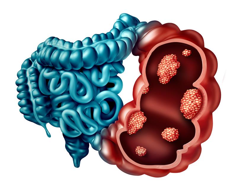 Lower CRC risk with ACEis, ARBs?