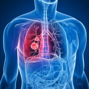 Inflammatory indices help gauge efficacy of atezolizumab against NSCLC