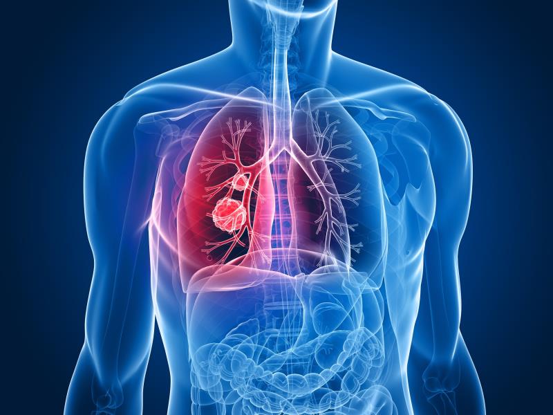 Inflammatory indices help gauge efficacy of atezolizumab against NSCLC