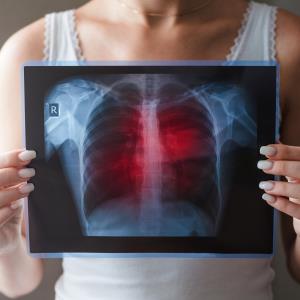 Lung cancer screening feasible for Asian women who don’t smoke