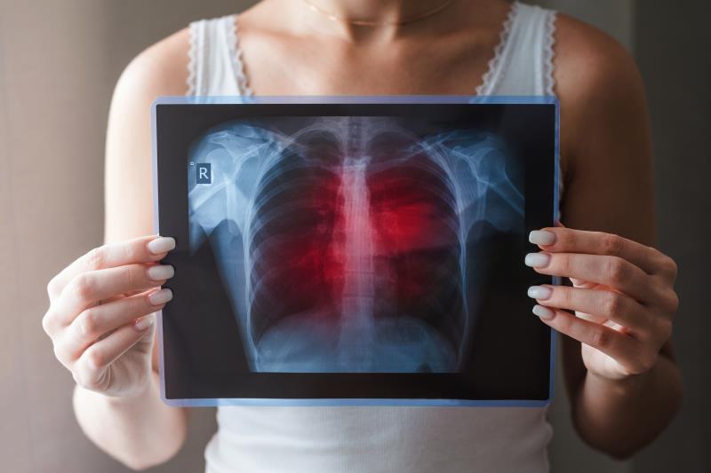 Smoking ups prolonged air leak risk after pulmonary surgery