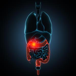 Microscopic colitis ups IBD risk