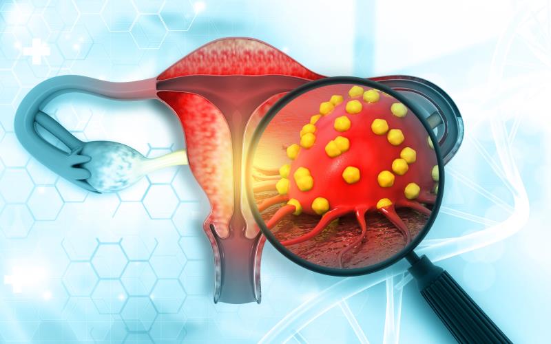 Maintenance selinexor promising for PFS in advanced/recurrent endometrial cancer