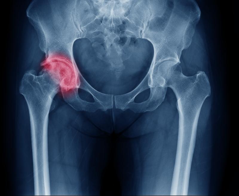 Fracture risk not higher with SGLT2 vs DPP4 inhibitors