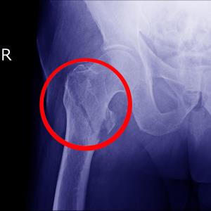 Male sex, comorbidities among factors tied to mortality risk after hip fracture