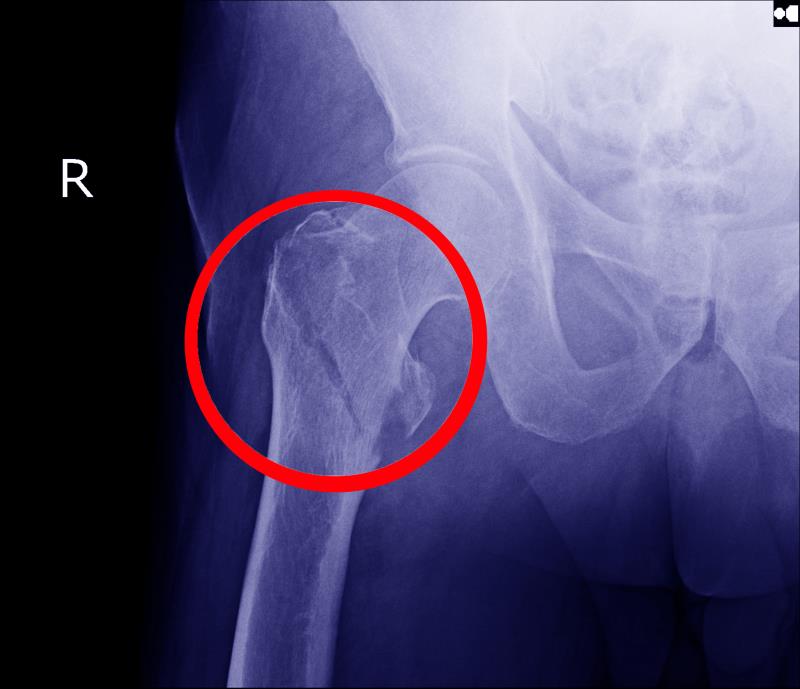 Male sex, comorbidities among factors tied to mortality risk after hip fracture