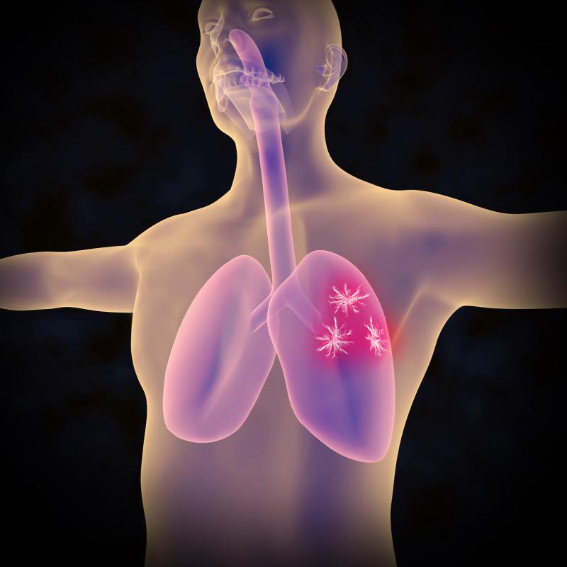 Is liposomal irinotecan superior to topotecan in relapsed small cell lung cancer?