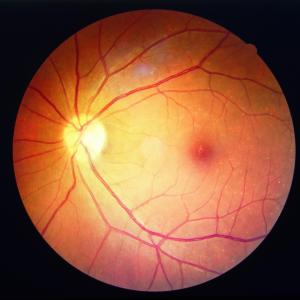 Duration of use, cumulative dose tied to HCQ-induced retinopathy in SLE