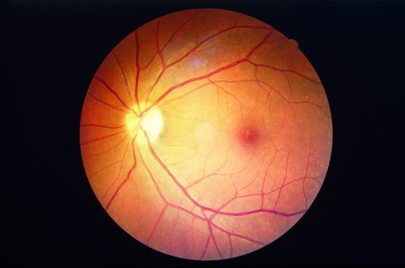 Duration of use, cumulative dose tied to HCQ-induced retinopathy in SLE