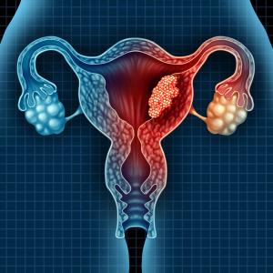 Progestin shows therapeutic potential in PR-positive endometrial cancer