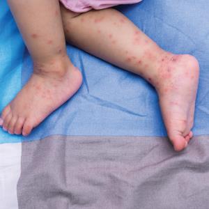 Managing hand, foot, and mouth disease (HFMD) in primary care