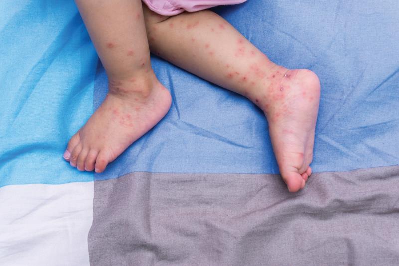 Managing hand, foot, and mouth disease (HFMD) in primary care