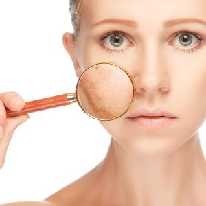 Topical therapy plus microneedling safe, effective in melasma management