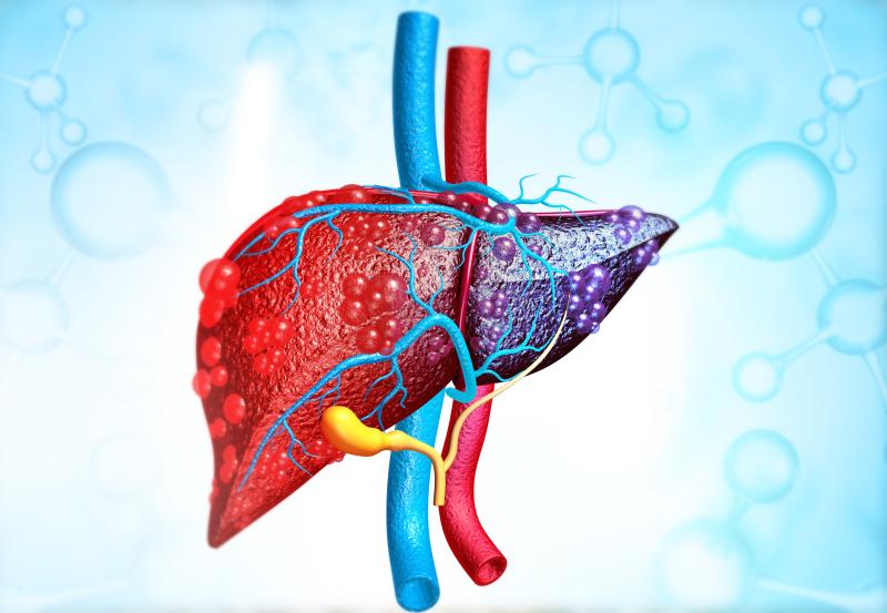 NAFLD ups risk of hepatocellular carcinoma in patients with suppressed CHB