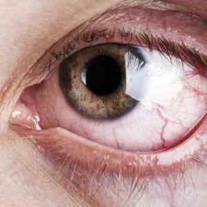 PCSK9 inhibitors linked to ocular disorders