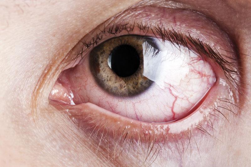 PCSK9 inhibitors linked to ocular disorders