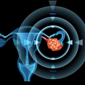 MicroRNA enrichment in plasma may be indicative of ovarian cancer