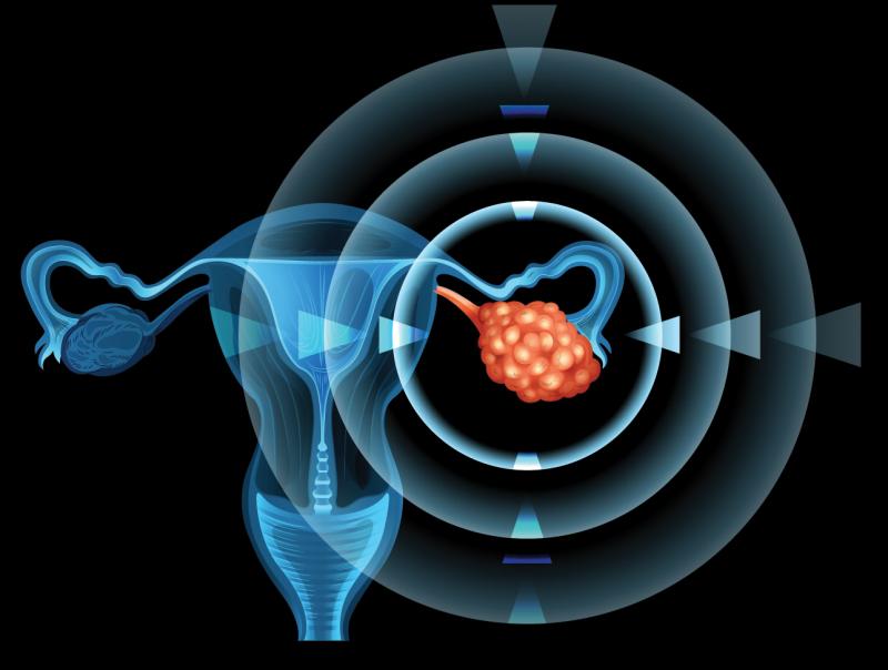 MicroRNA enrichment in plasma may be indicative of ovarian cancer