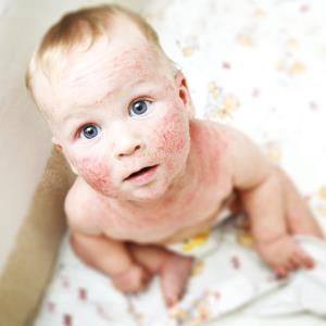 Managing paediatric eczema in primary care