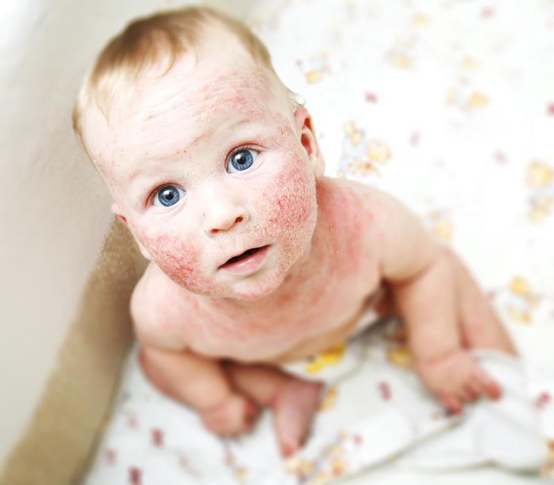 Managing paediatric eczema in primary care