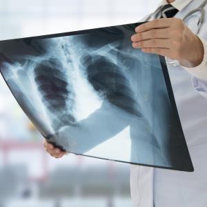 Being hospitalized for ACS worsens long-term risk of pneumonia