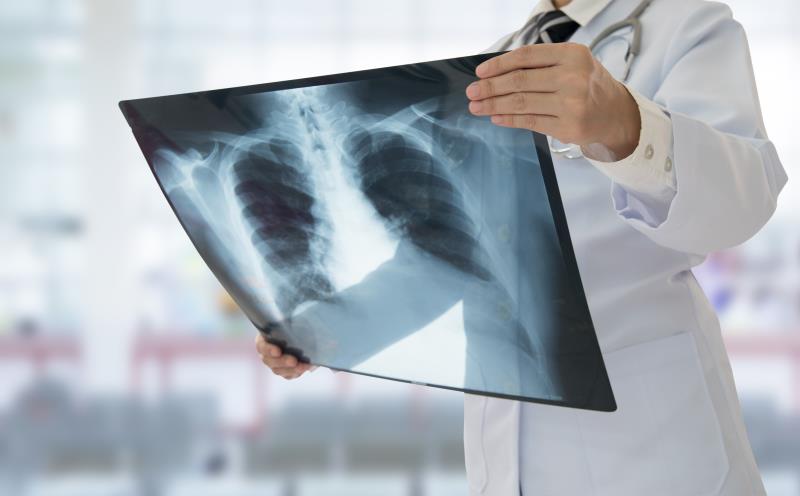 Being hospitalized for ACS worsens long-term risk of pneumonia