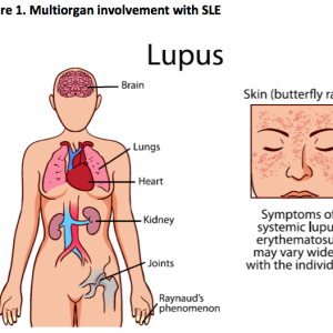 Limited health literacy tied to low knowledge on SLE