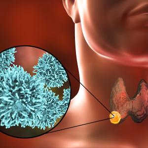 Anlotinib shows promise for radioiodine-refractory differentiated thyroid carcinoma