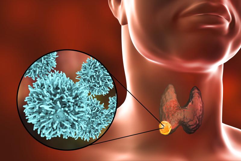 Anlotinib shows promise for radioiodine-refractory differentiated thyroid carcinoma