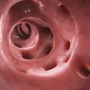 Frequent bowel movements a risk factor for diverticulitis