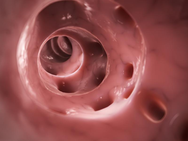 Elective sigmoid resection wards off recurrent diverticulitis, enhance quality of life